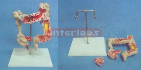 DESK TYPE,COMMON PATHOLOGIES OF COLON CAECUM AND RECTUM MODEL WITH DESCRIPTION PLATE